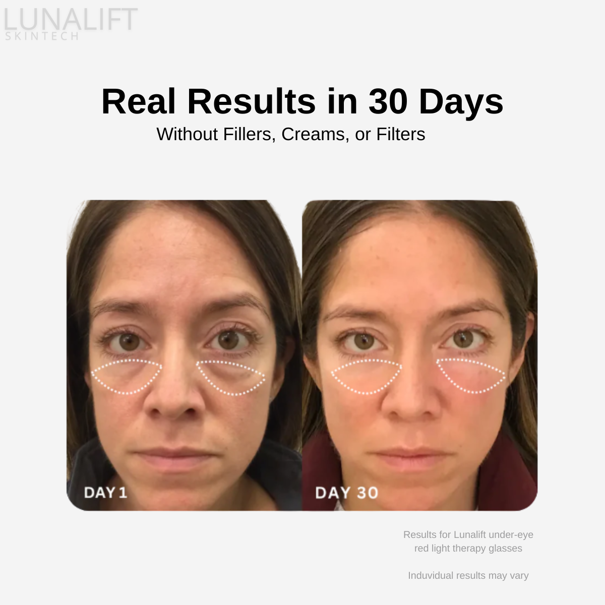 Reverse Tired, Aging Eyes With Lunalift™ Therapy