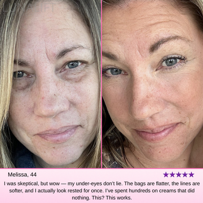 Reverse Tired, Aging Eyes With Lunalift™ Therapy