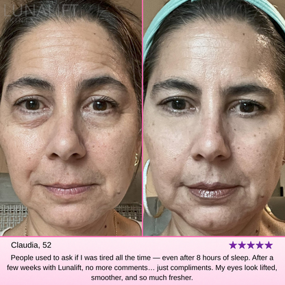 Reverse Tired, Aging Eyes With Lunalift™ Therapy
