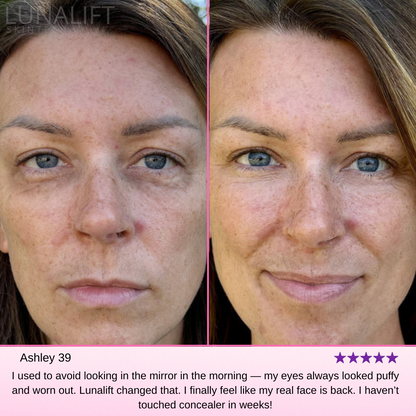 Reverse Tired, Aging Eyes With Lunalift™ Therapy